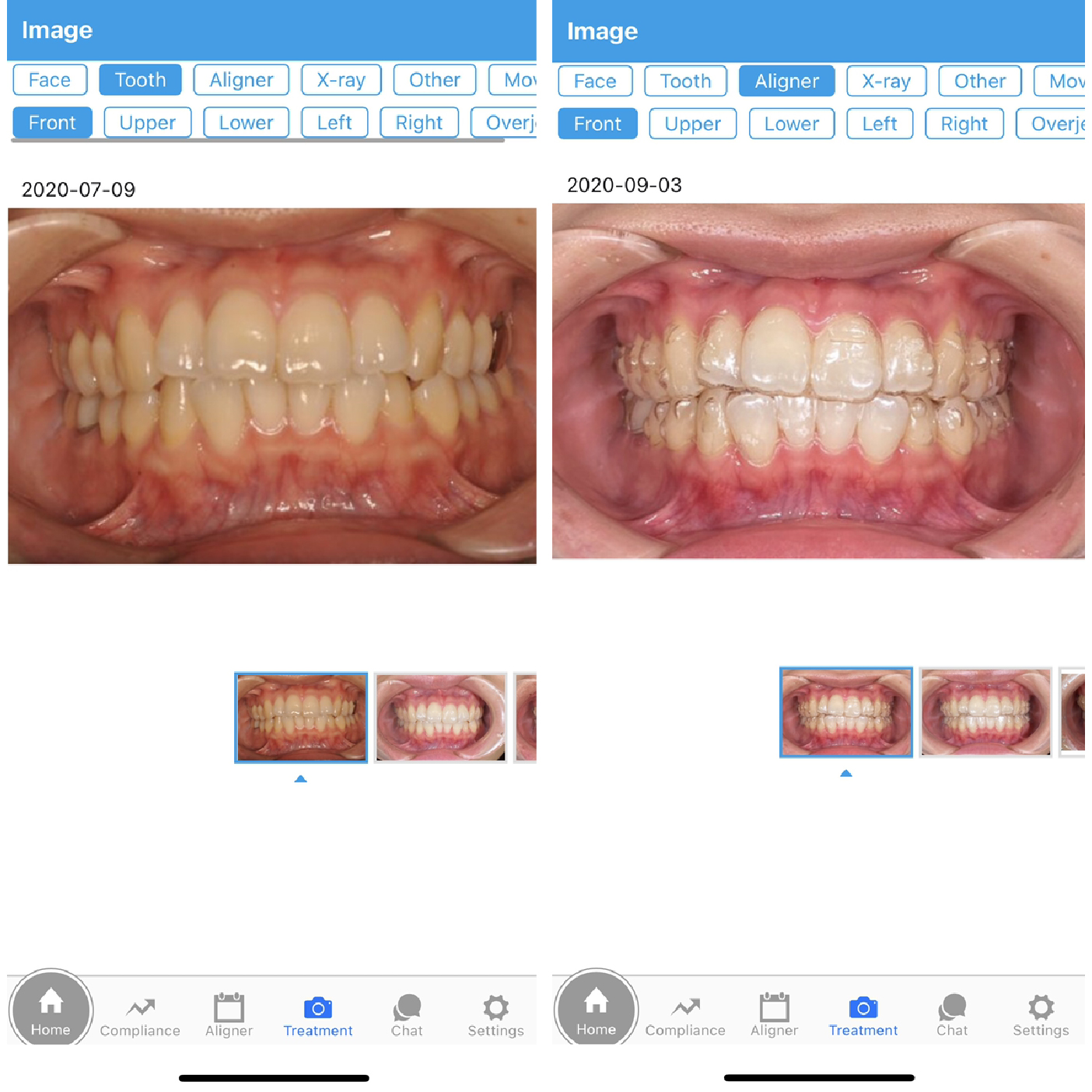 スマホで治療経過が確認できる！『Orthocomm(オルソコム)』をご紹介します(栄養士E)【マウスピース矯正】