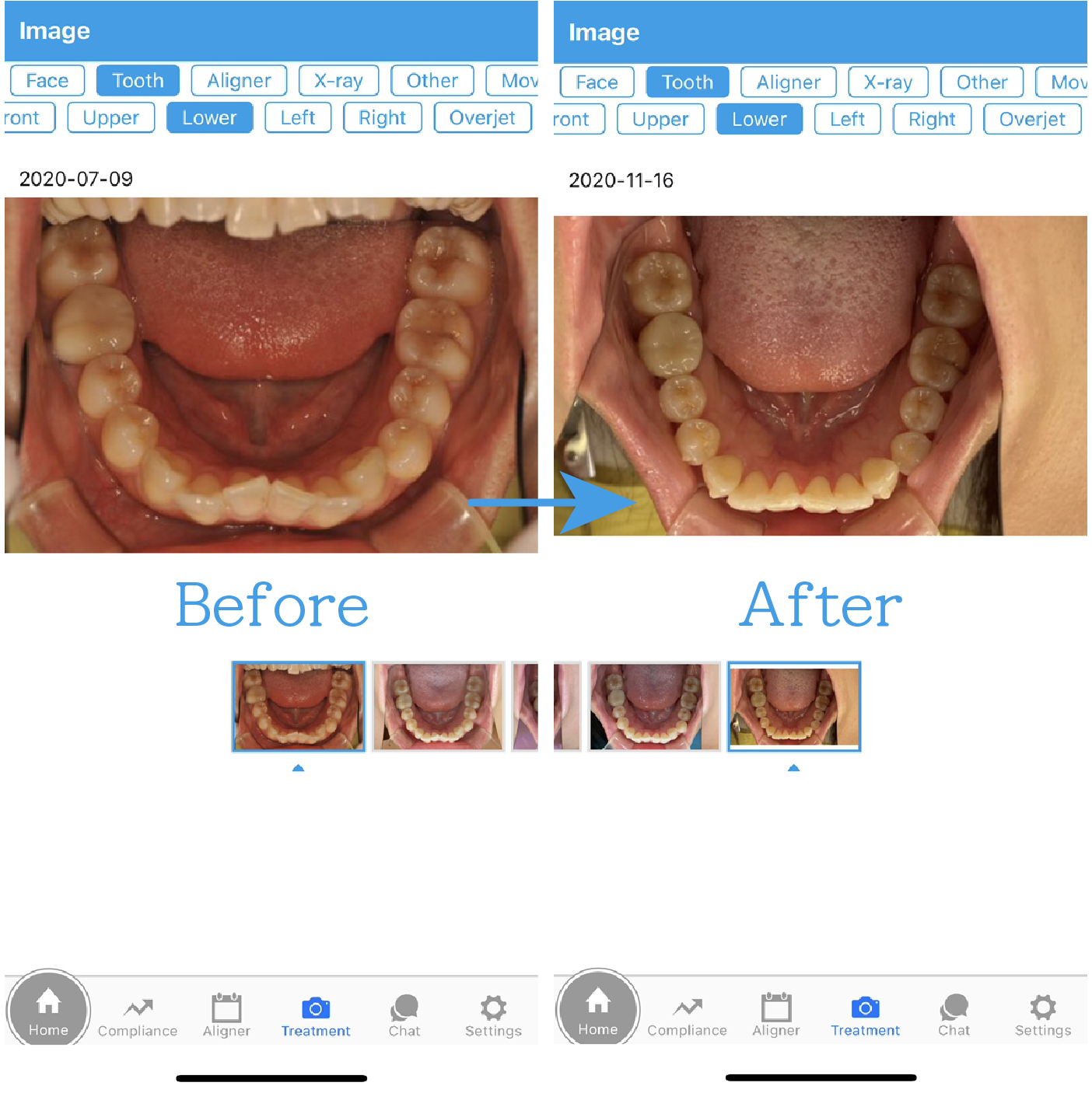 スマホで治療経過が確認できる！『Orthocomm(オルソコム)』をご紹介します(栄養士E)【マウスピース矯正】