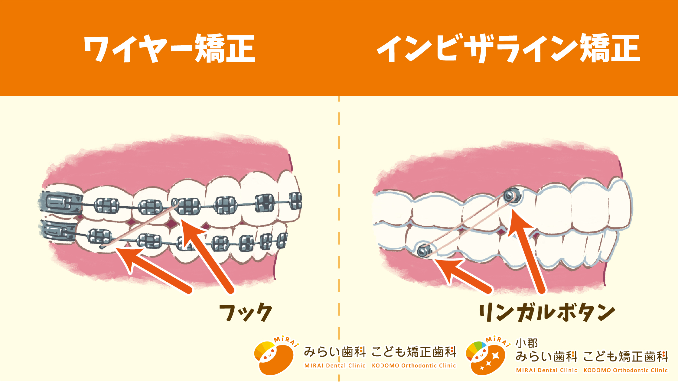 インビザライン矯正で使用する「リンガルボタン」ってなに？(栄養士E)【マウスピース矯正】