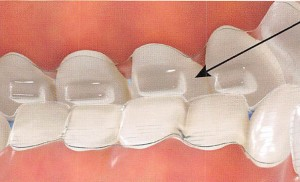 インビザライン矯正のバイトランプについて(受付S)【マウスピース矯正】