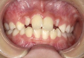 【7歳11か月】上顎両側側切歯捻転（上の横の前歯のねじれ）