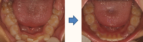 歯並びの調整